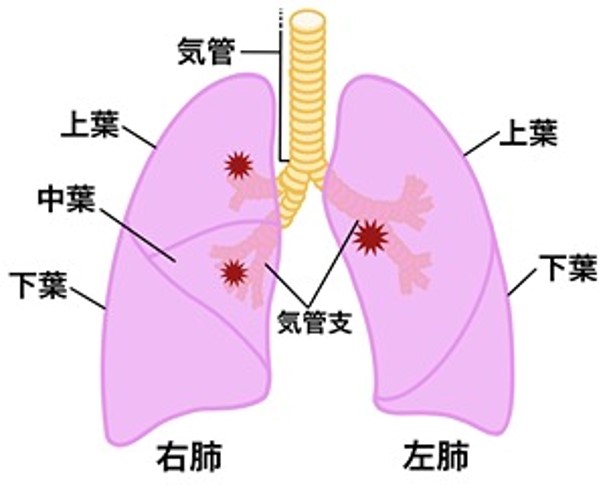 痰がでる肺がんの部位