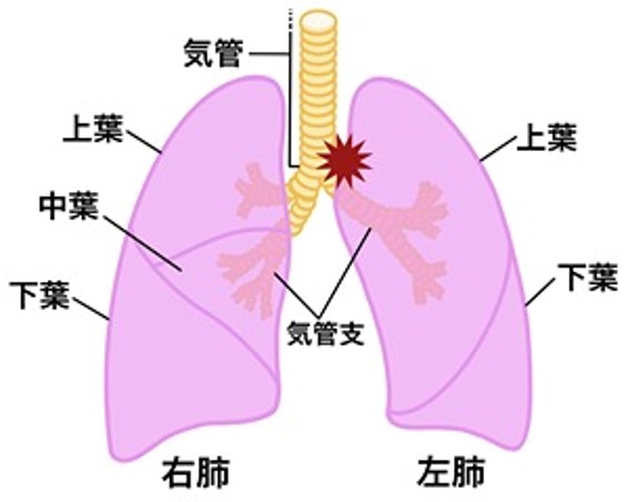 呼吸困難がでる肺がんの部位