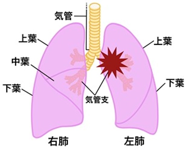 中枢肺癌の部位